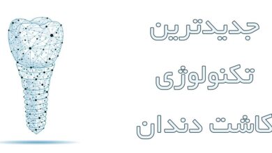 جدیدترین تکنولوژی کاشت دندان 19 جدیدترین تکنولوژی کاشت دندان