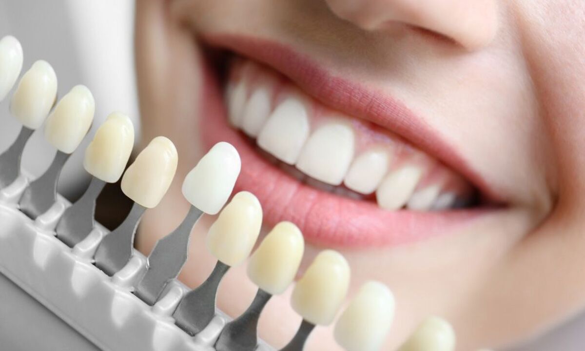 مزایای لمینت دندان چیست؟