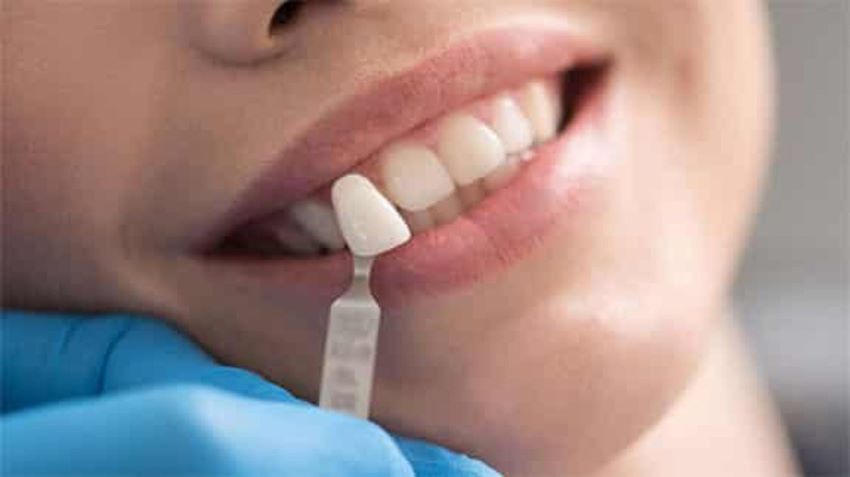لمینت دندان با دندانپزشکی دکتر هومن پاک نیت